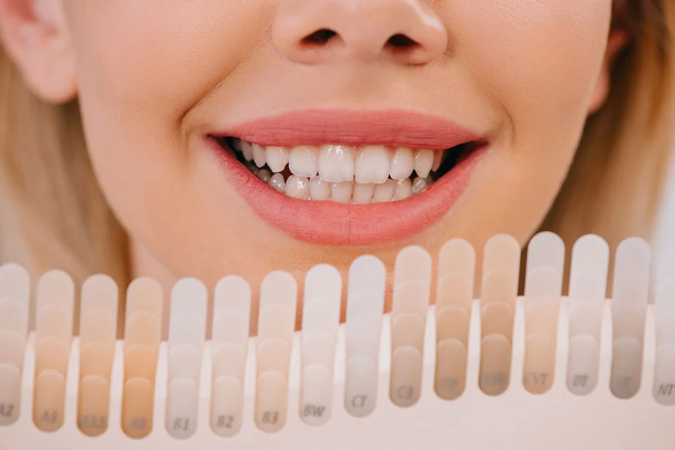 Why North Hill Dental Is Your Go-To for Porcelain Veneers Near Me