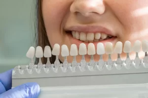 Porcelain Veneers Near Me