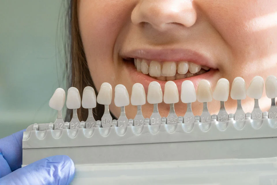 Porcelain Veneers Near Me