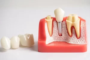 Dental Implants vs. Bridges: Which One Is Right for You?