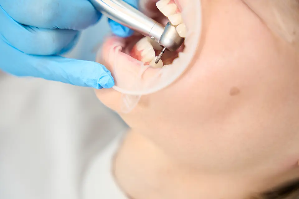 How To Manage an Exposed Tooth Root