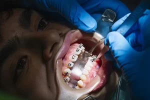 Invisalign or Braces: Which One Straightens Teeth Faster?