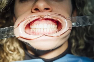 Can Gingivitis Be Reversed?