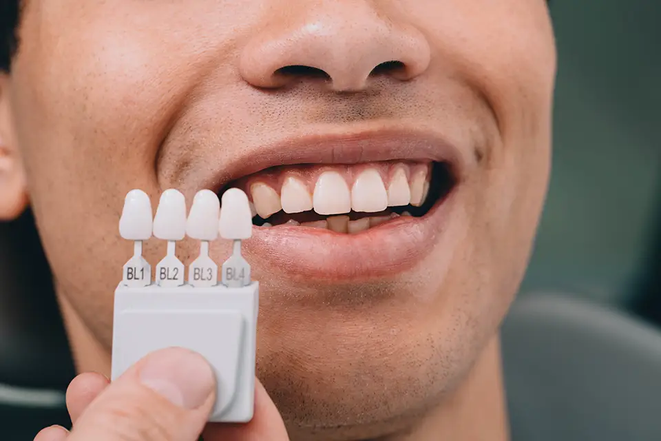 Which Veneers Are Best for You?