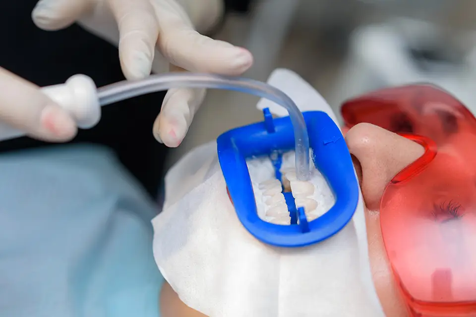 Safe Fluoride Treatment for Kids in Richmond Hill