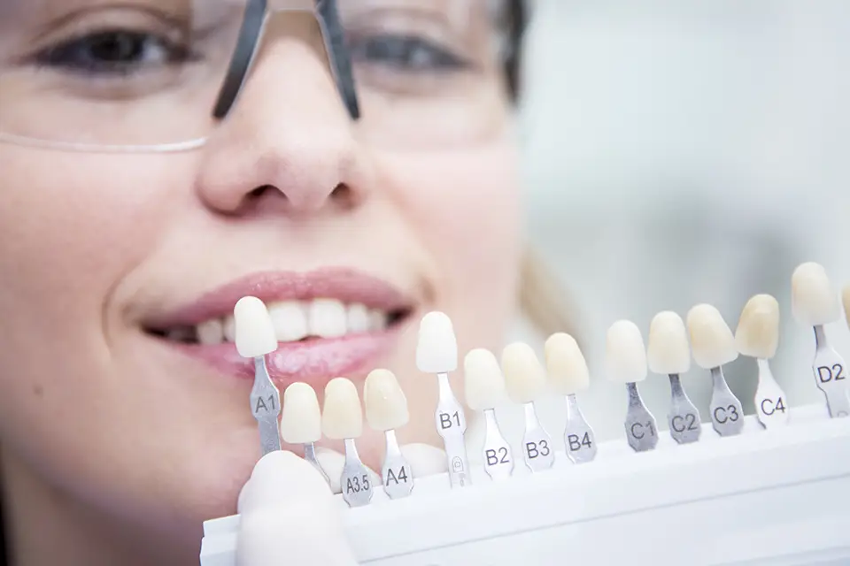 Cost In Canada: Veneers vs Lumineers