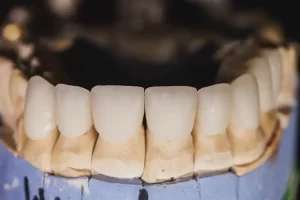 Veneers vs Crowns: Differences, Cost in Ontario, and Which Option Fits Your Tooth