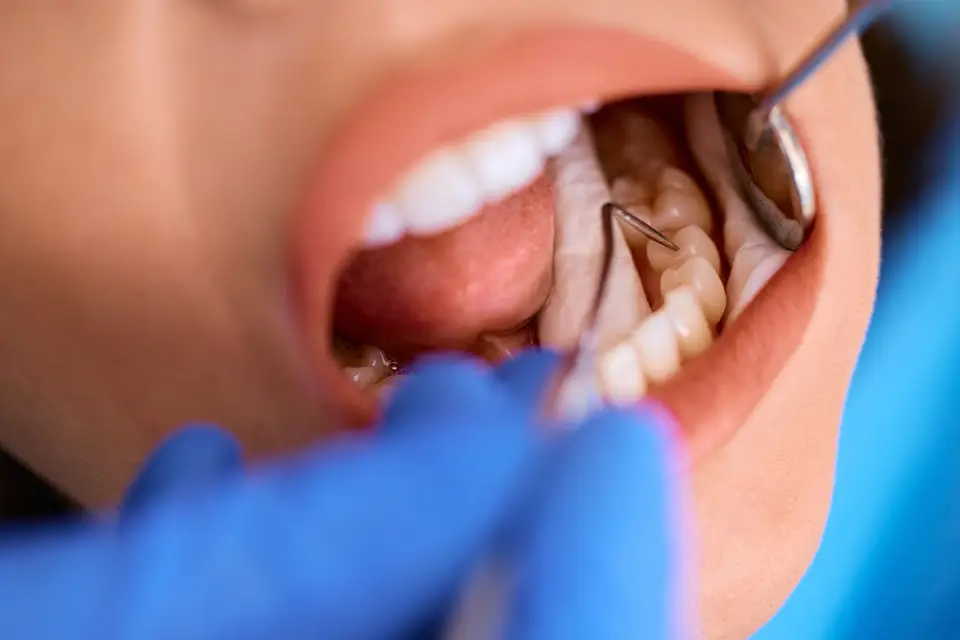 How to Make Fillings Last Longer After Replacing Old Dental Fillings