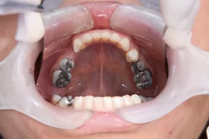 When Should You Replace Old Dental Fillings?