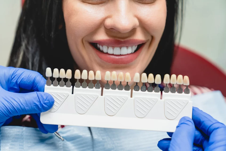 Composite Veneers Composite Veneers
