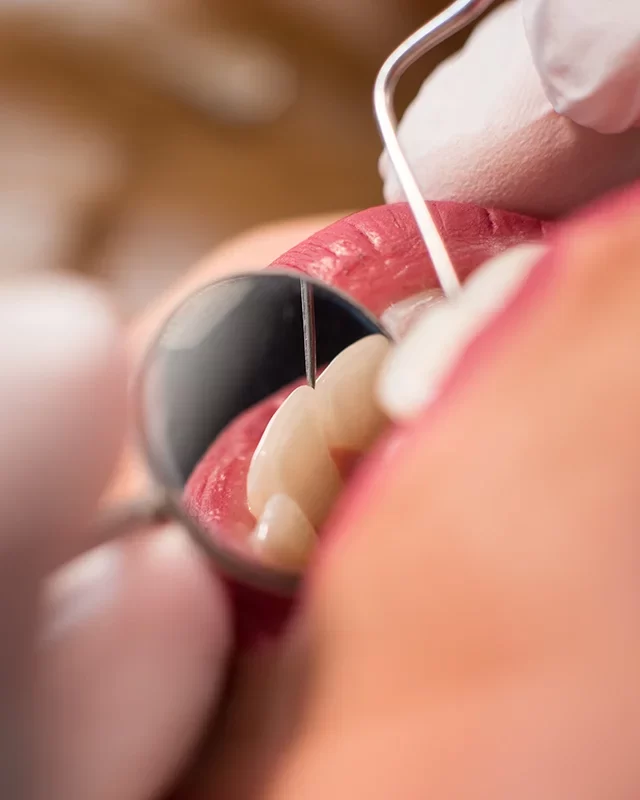 Benefits of Dental Bonding