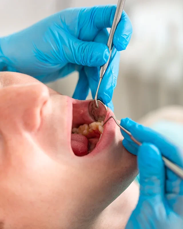 Benefits of Dental Sealants