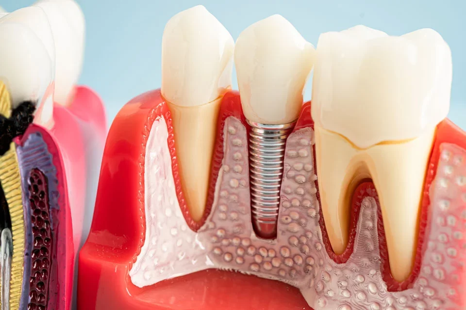 How Long Does Each Type of Dental Implant Take?