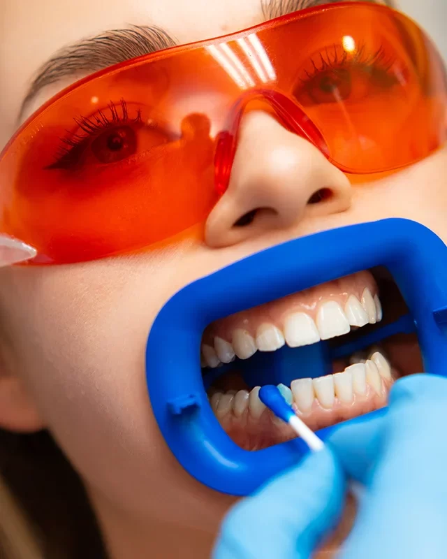 Benefits of Professional Teeth Whitening