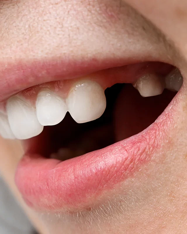Benefits of Dental Extractions