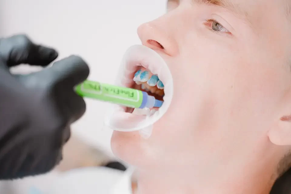 How Often Should You Get Fluoride Treatment?