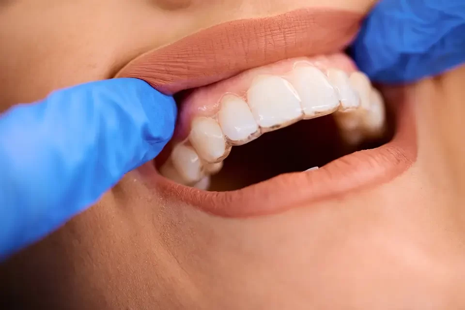 Invisalign or Braces: Making the Choice