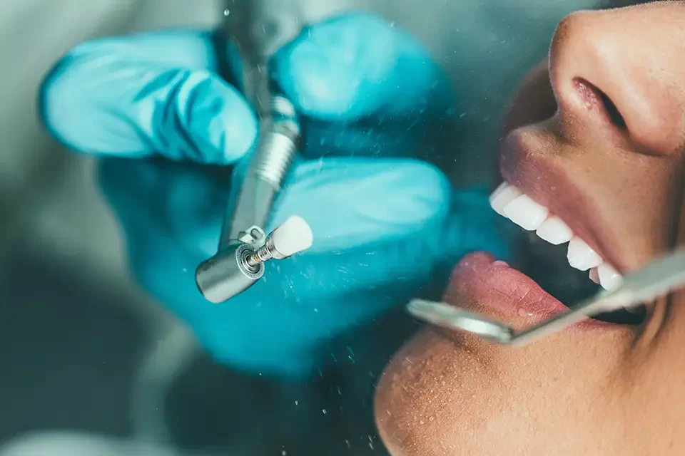 What Causes Dental Fillings to Fail?: The Short Version