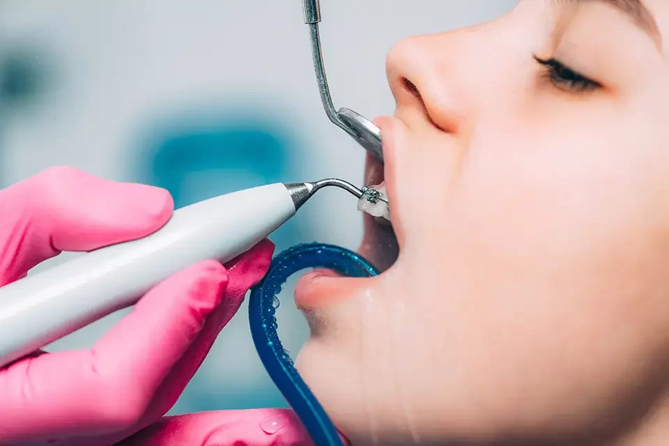 orthodontist-cleaning-girl-s-teeth-with-dental What Are Dental Sealants' Benefits: Why Consider This Preventive Treatment?